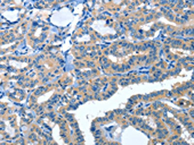 The image on the left is immunohistochemistry of paraffin-embedded Human thyroid cancer tissue using AMDHD2 Antibody(AMDHD2 Antibody) at dilution 1/30, on the right is treated with fusion protein. (Original magnification: ×200)Rabbit anti-Human AMDHD2 Polyclonal Antibody