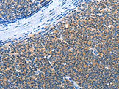 The image on the left is immunohistochemistry of paraffin-embedded Human lymphoma cancer tissue using the antibody Antibody) at dilution 1/30, on the right is treated with fusion protein. (Original magnification: ×200)Rabbit anti-Human AMDHD2 Polyclonal Antibody