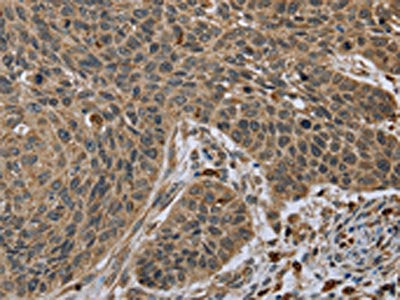 The image on the left is immunohistochemistry of paraffin-embedded Human lung cancer tissue using TNFRSF13C Antibody(TNFRSF13C Antibody) at dilution 1/45, on the right is treated with synthetic peptide. (Original magnification: ×200)Rabbit anti-Human TNFRSF13C Polyclonal Antibody