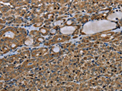 The image on the left is immunohistochemistry of paraffin-embedded Human thyroid cancer tissue using the antibody Antibody) at dilution 1/45, on the right is treated with synthetic peptide. (Original magnification: ×200)Rabbit anti-Human TNFRSF13C Polyclonal Antibody