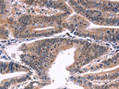 The image on the left is immunohistochemistry of paraffin-embedded Human colon cancer tissue using BAP1 Antibody(BAP1 Antibody) at dilution 1/40, on the right is treated with fusion protein. (Original magnification: ×200)