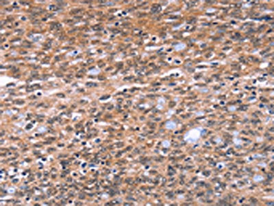 The image on the left is immunohistochemistry of paraffin-embedded Human ovarian cancer tissue using the antibody Antibody) at dilution 1/40, on the right is treated with fusion protein. (Original magnification: ×200)