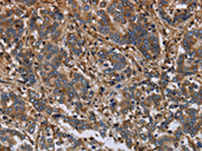 The image on the left is immunohistochemistry of paraffin-embedded Human liver cancer tissue using the antibody Antibody) at dilution 1/40, on the right is treated with fusion protein. (Original magnification: ×200)