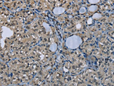 The image on the left is immunohistochemistry of paraffin-embedded Human thyroid cancer tissue using GYS1 Antibody(GYS1 Antibody) at dilution 1/50, on the right is treated with fusion protein. (Original magnification: ×200)Rabbit anti-Human GYS1 Polyclonal Antibody