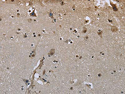 The image on the left is immunohistochemistry of paraffin-embedded Human brain tissue using the antibody Antibody) at dilution 1/50, on the right is treated with fusion protein. (Original magnification: ×200)Rabbit anti-Human GYS1 Polyclonal Antibody