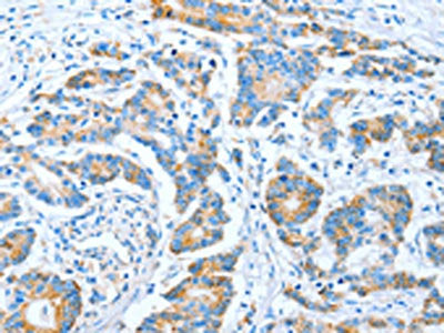 The image on the left is immunohistochemistry of paraffin-embedded Human colon cancer tissue using IMMT Antibody(IMMT Antibody) at dilution 1/70, on the right is treated with fusion protein. (Original magnification: ×200)Rabbit anti-Human IMMT Polyclonal Antibody