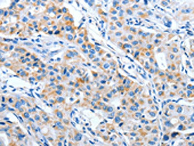 The image on the left is immunohistochemistry of paraffin-embedded Human lung cancer tissue using the antibody Antibody) at dilution 1/70, on the right is treated with fusion protein. (Original magnification: ×200)Rabbit anti-Human IMMT Polyclonal Antibody