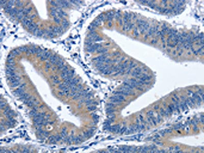 The image on the left is immunohistochemistry of paraffin-embedded Human colon cancer tissue using CDK5RAP3 Antibody(CDK5RAP3 Antibody) at dilution 1/40, on the right is treated with fusion protein. (Original magnification: ×200)Rabbit anti-Human CDK5RAP3 Polyclonal Antibody