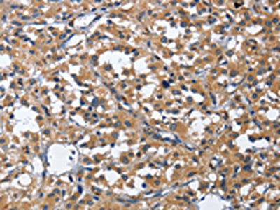 The image on the left is immunohistochemistry of paraffin-embedded Human thyroid cancer tissue using the antibody Antibody) at dilution 1/40, on the right is treated with fusion protein. (Original magnification: ×200)Rabbit anti-Human CDK5RAP3 Polyclonal Antibody