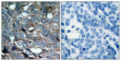Immunohistochemical analysis of paraffin-embedded human breast carcinoma tissue using ASK1(Phospho-Ser83) Antibody(left) or the same antibody preincubated with blocking peptide(right).