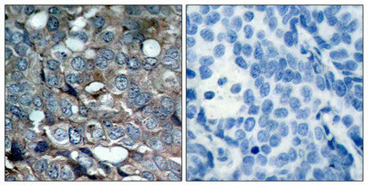Immunohistochemical analysis of paraffin-embedded human breast carcinoma tissue using ASK1(Phospho-Ser83) Antibody(left) or the same antibody preincubated with blocking peptide(right).
