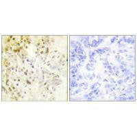 Immunohistochemical analysis of paraffin-embedded human breast carcinoma tissue using Cyclin-L1 antibody.