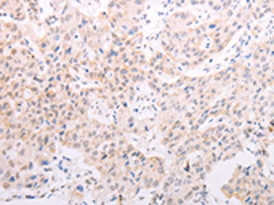 The image on the left is immunohistochemistry of paraffin-embedded Human lung cancer tissue using TYR Antibody(TYR Antibody) at dilution 1/30, on the right is treated with fusion protein. (Original magnification: ×200)Rabbit anti-Human TYR Polyclonal Antibody
