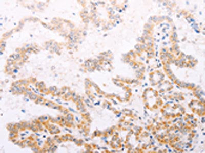 The image on the left is immunohistochemistry of paraffin-embedded Human thyroid cancer tissue using the antibody Antibody) at dilution 1/30, on the right is treated with fusion protein. (Original magnification: ×200)Rabbit anti-Human TYR Polyclonal Antibody