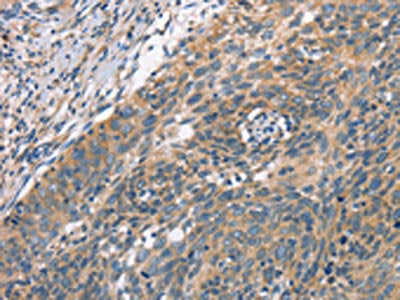 The image on the left is immunohistochemistry of paraffin-embedded Human cervical cancer tissue using PLEKHO1 Antibody(PLEKHO1 Antibody) at dilution 1/70, on the right is treated with fusion protein. (Original magnification: ×200)Rabbit anti-Human PLEKHO1 Polyclonal Antibody