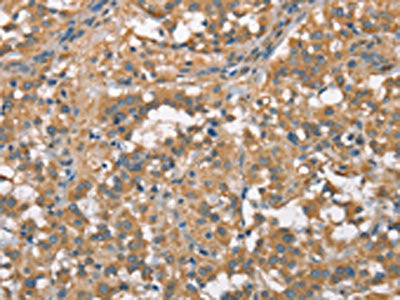 The image on the left is immunohistochemistry of paraffin-embedded Human thyroid cancer tissue using the antibody Antibody) at dilution 1/70, on the right is treated with fusion protein. (Original magnification: ×200)Rabbit anti-Human PLEKHO1 Polyclonal Antibody