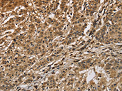 The image is immunohistochemistry of paraffin-embedded Human gastric cancer tissue using CALU Antibody(CALU Antibody) at dilution 1/40. (Original magnification: ×200)