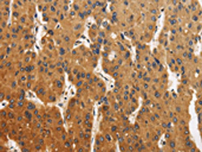 The image is immunohistochemistry of paraffin-embedded Human liver cancer tissue using the antibody Antibody) at dilution 1/40. (Original magnification: ×200)