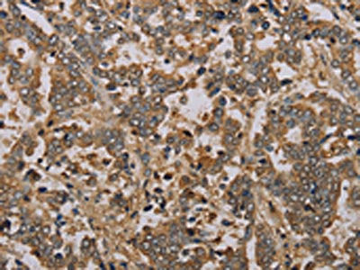 The image on the left is immunohistochemistry of paraffin-embedded Human liver cancer tissue using NOV Antibody(NOV Antibody) at dilution 1/25, on the right is treated with fusion protein. (Original magnification: ×200)Rabbit anti-Human NOV Polyclonal Antibody