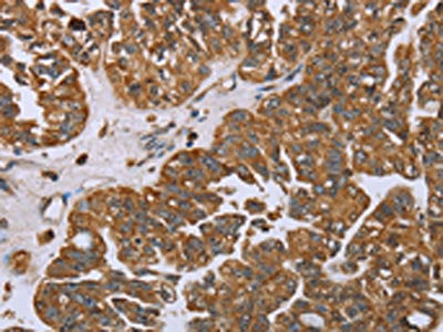 The image on the left is immunohistochemistry of paraffin-embedded Human ovarian cancer tissue using the antibody Antibody) at dilution 1/25, on the right is treated with fusion protein. (Original magnification: ×200)Rabbit anti-Human NOV Polyclonal Antibody