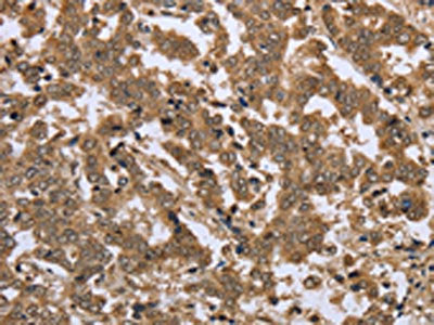 The image on the left is immunohistochemistry of paraffin-embedded Human liver cancer tissue using IKBKE Antibody(IKBKE Antibody) at dilution 1/25, on the right is treated with fusion protein. (Original magnification: ×200)