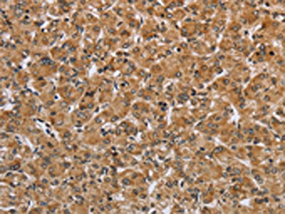 The image on the left is immunohistochemistry of paraffin-embedded Human prostate cancer tissue using the antibody Antibody) at dilution 1/25, on the right is treated with fusion protein. (Original magnification: ×200)