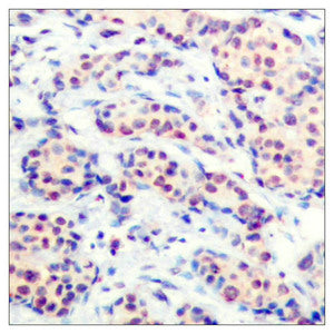 Immunohistochemical analysis of paraffin-embedded human breast carcinoma tissue using JunD(Ab-255) Antibody