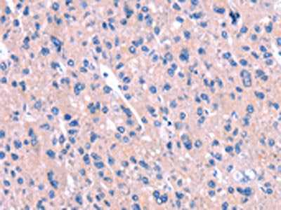 The image on the left is immunohistochemistry of paraffin-embedded Human liver cancer tissue using ENPP4 Antibody(ENPP4 Antibody) at dilution 1/15, on the right is treated with synthetic peptide. (Original magnification: ×200)Rabbit anti-Human ENPP4 Polyclonal Antibody