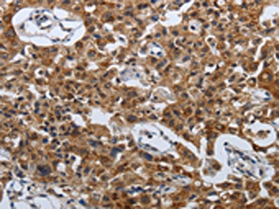 The image on the left is immunohistochemistry of paraffin-embedded Human lung cancer tissue using SPAG4 Antibody(SPAG4 Antibody) at dilution 1/50, on the right is treated with synthetic peptide. (Original magnification: ×200)Rabbit anti-Human SPAG4 Polyclonal Antibody