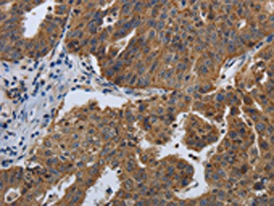 The image on the left is immunohistochemistry of paraffin-embedded Human ovarian cancer tissue using the antibody Antibody) at dilution 1/50, on the right is treated with synthetic peptide. (Original magnification: ×200)Rabbit anti-Human SPAG4 Polyclonal Antibody