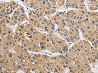 The image on the left is immunohistochemistry of paraffin-embedded Human liver cancer tissue using ARHGAP15 Antibody(ARHGAP15 Antibody) at dilution 1/50, on the right is treated with fusion protein. (Original magnification: ×200)Rabbit anti-Human ARHGAP15 Polyclonal Antibody