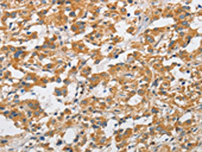 The image on the left is immunohistochemistry of paraffin-embedded Human thyroid cancer tissue using the antibody Antibody) at dilution 1/50, on the right is treated with fusion protein. (Original magnification: ×200)Rabbit anti-Human ARHGAP15 Polyclonal Antibody