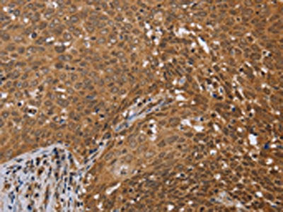 The image on the left is immunohistochemistry of paraffin-embedded Human cervical cancer tissue using FKBP8 Antibody(FKBP8 Antibody) at dilution 1/50, on the right is treated with fusion protein. (Original magnification: ×200)Rabbit anti-Human FKBP8 Polyclonal Antibody