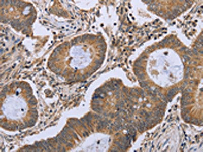 The image on the left is immunohistochemistry of paraffin-embedded Human colon cancer tissue using the antibody Antibody) at dilution 1/50, on the right is treated with fusion protein. (Original magnification: ×200)Rabbit anti-Human FKBP8 Polyclonal Antibody