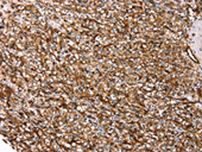 The image on the left is immunohistochemistry of paraffin-embedded Human prostate cancer tissue using the antibody Antibody) at dilution 1/20, on the right is treated with synthetic peptide. (Original magnification: ×200)Rabbit anti-Human AQP1 Polyclonal Antibody