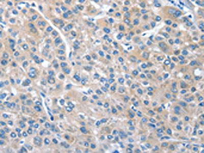The image on the left is immunohistochemistry of paraffin-embedded Human liver cancer tissue using CGB Antibody(CGB Antibody) at dilution 1/40, on the right is treated with fusion protein. (Original magnification: ×200)Rabbit anti-Human CGB Polyclonal Antibody