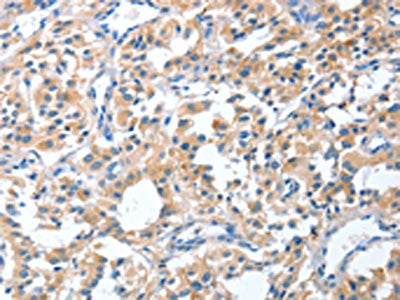 The image on the left is immunohistochemistry of paraffin-embedded Human thyroid cancer tissue using the antibody Antibody) at dilution 1/40, on the right is treated with fusion protein. (Original magnification: ×200)Rabbit anti-Human CGB Polyclonal Antibody