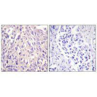Immunohistochemistry analysis of paraffin-embedded human breast carcinoma tissue using UBE1L antibody.Rabbit anti-Human UBA7 Polyclonal Antibody