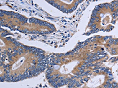 The image on the left is immunohistochemistry of paraffin-embedded Human colon cancer tissue using CA4 Antibody(CA4 Antibody) at dilution 1/30, on the right is treated with fusion protein. (Original magnification: ×200)