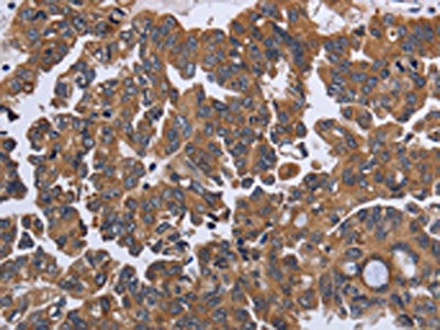 The image on the left is immunohistochemistry of paraffin-embedded Human ovarian cancer tissue using the antibody Antibody) at dilution 1/30, on the right is treated with fusion protein. (Original magnification: ×200)