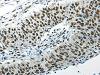 The image on the left is immunohistochemistry of paraffin-embedded Human lung cancer tissue using HNRNPM Antibody(HNRNPM Antibody) at dilution 1/35, on the right is treated with synthetic peptide. (Original magnification: ×200)Rabbit anti-Human HNRNPM Polyclonal Antibody