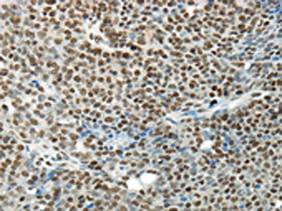 The image on the left is immunohistochemistry of paraffin-embedded Human ovarian cancer tissue using the antibody Antibody) at dilution 1/35, on the right is treated with synthetic peptide. (Original magnification: ×200)Rabbit anti-Human HNRNPM Polyclonal Antibody