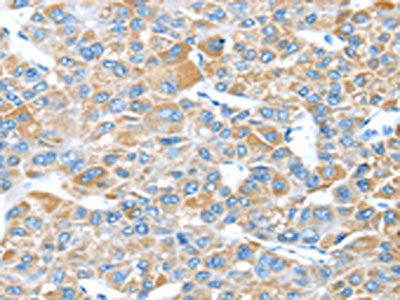 The image on the left is immunohistochemistry of paraffin-embedded Human liver cancer tissue using LEFTY2 Antibody(LEFTY2 Antibody) at dilution 1/35, on the right is treated with fusion protein. (Original magnification: ×200)