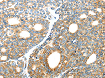 The image on the left is immunohistochemistry of paraffin-embedded Human thyroid cancer tissue using the antibody Antibody) at dilution 1/35, on the right is treated with fusion protein. (Original magnification: ×200)