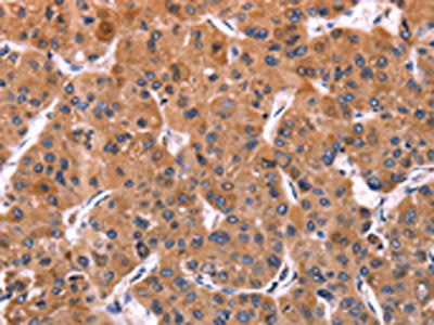 The image on the left is immunohistochemistry of paraffin-embedded Human liver cancer tissue using ERP29 Antibody(ERP29 Antibody) at dilution 1/40, on the right is treated with synthetic peptide. (Original magnification: ×200)Rabbit anti-Human ERP29 Polyclonal Antibody