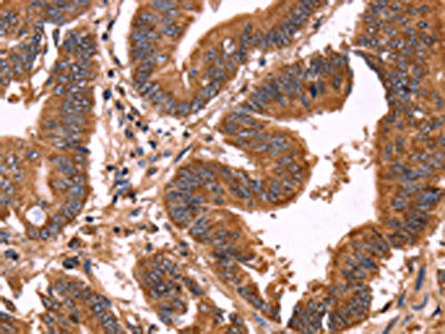 The image on the left is immunohistochemistry of paraffin-embedded Human colon cancer tissue using the antibody Antibody) at dilution 1/40, on the right is treated with synthetic peptide. (Original magnification: ×200)Rabbit anti-Human ERP29 Polyclonal Antibody