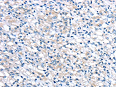 The image on the left is immunohistochemistry of paraffin-embedded Human prostate cancer tissue using LEFTY2 Antibody(LEFTY2 Antibody) at dilution 1/20, on the right is treated with fusion protein. (Original magnification: ×200)