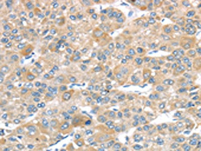 The image on the left is immunohistochemistry of paraffin-embedded Human liver cancer tissue using the antibody Antibody) at dilution 1/20, on the right is treated with fusion protein. (Original magnification: ×200)