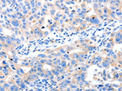 The image on the left is immunohistochemistry of paraffin-embedded Human ovarian cancer tissue using LRPAP1 Antibody(LRPAP1 Antibody) at dilution 1/80, on the right is treated with synthetic peptide. (Original magnification: ×200)