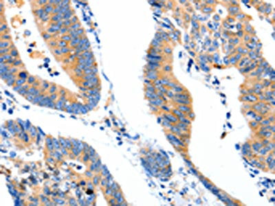 The image on the left is immunohistochemistry of paraffin-embedded Human colon cancer tissue using the antibody Antibody) at dilution 1/80, on the right is treated with synthetic peptide. (Original magnification: ×200)